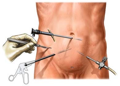 laparoscopic hernia surgery in kolkata - Dr. Kushankur Guha