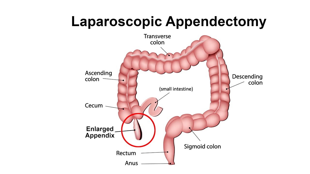 Laparoscopic Appendicectomy in kolkata